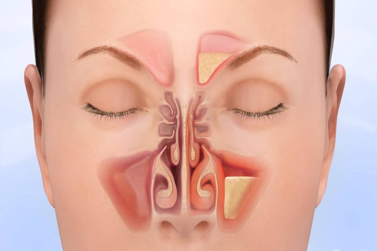 What Is Sinus Infection Definition Symptoms Treatment