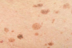 Dark Spots on the Skin – Causes, Diseases, Treatment and More